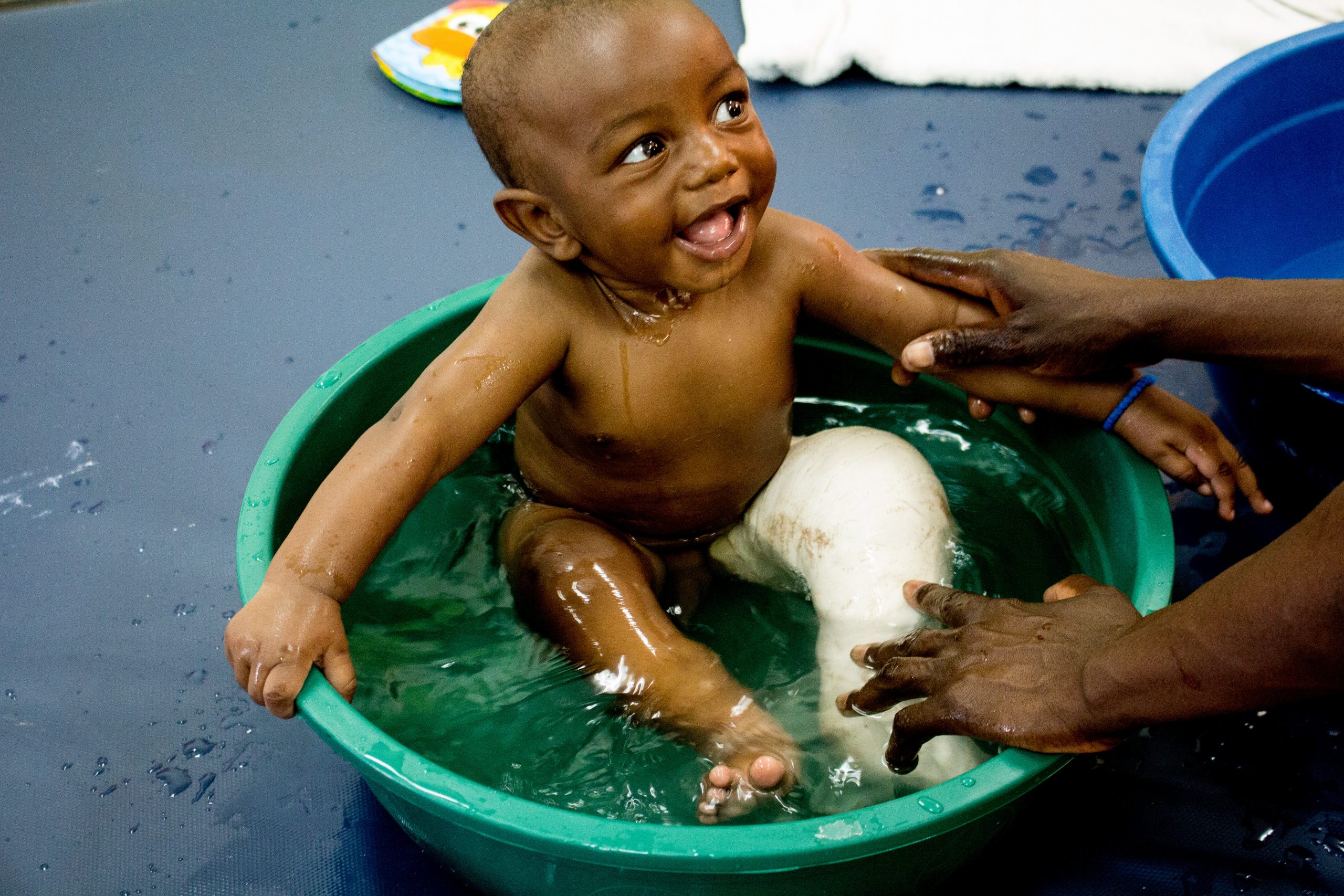 how-clubfoot-treatment-works-hope-walks