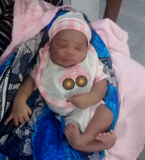 Baby born with clubfoot in Benin before starting Ponseti treatment